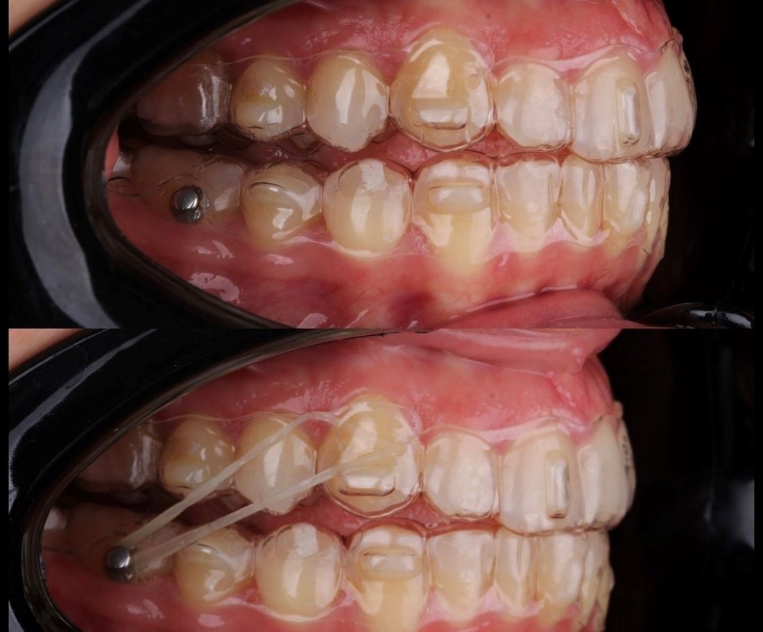 Elastici ortodontici: cosa sono e come funzionano?