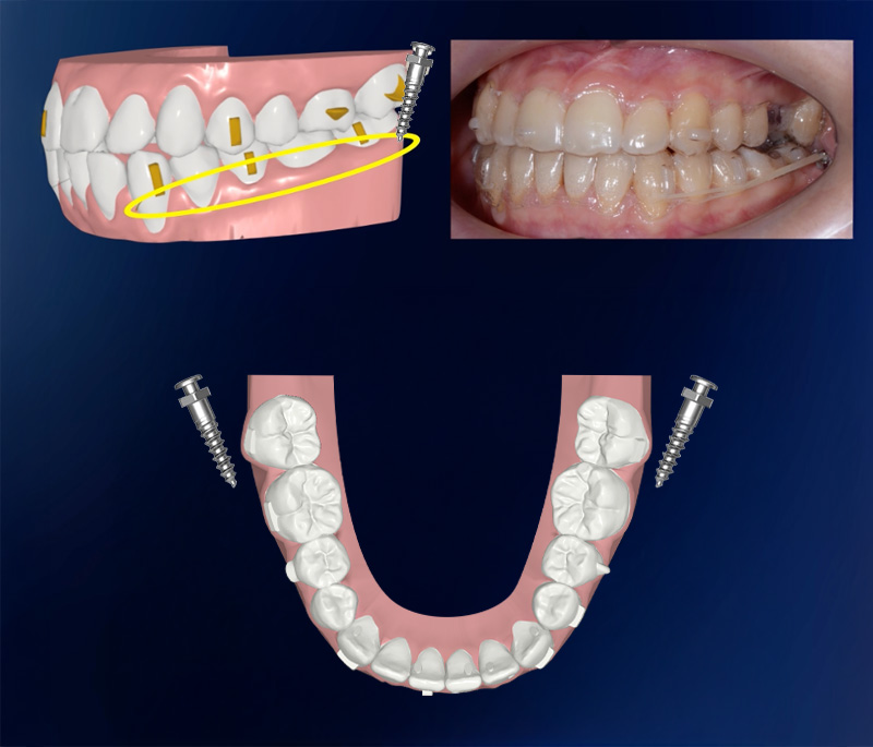 Protocollo miniviti FlexiLigner